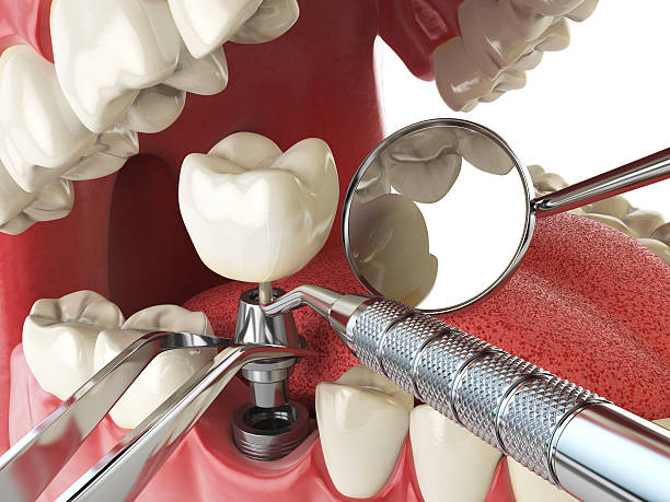 Best Emergency Root Canal Treatment in Benton, KY